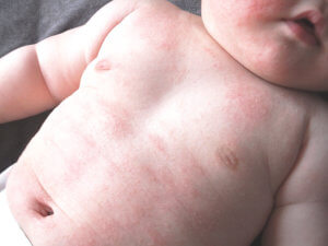 乳児湿疹 対策